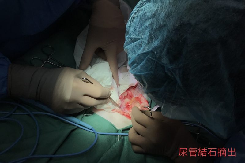 外科手術／尿管結石の摘出